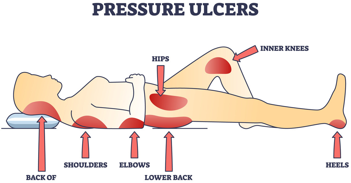 Decubitus jelentése – mit takar pontosan a felfekvés fogalma?
