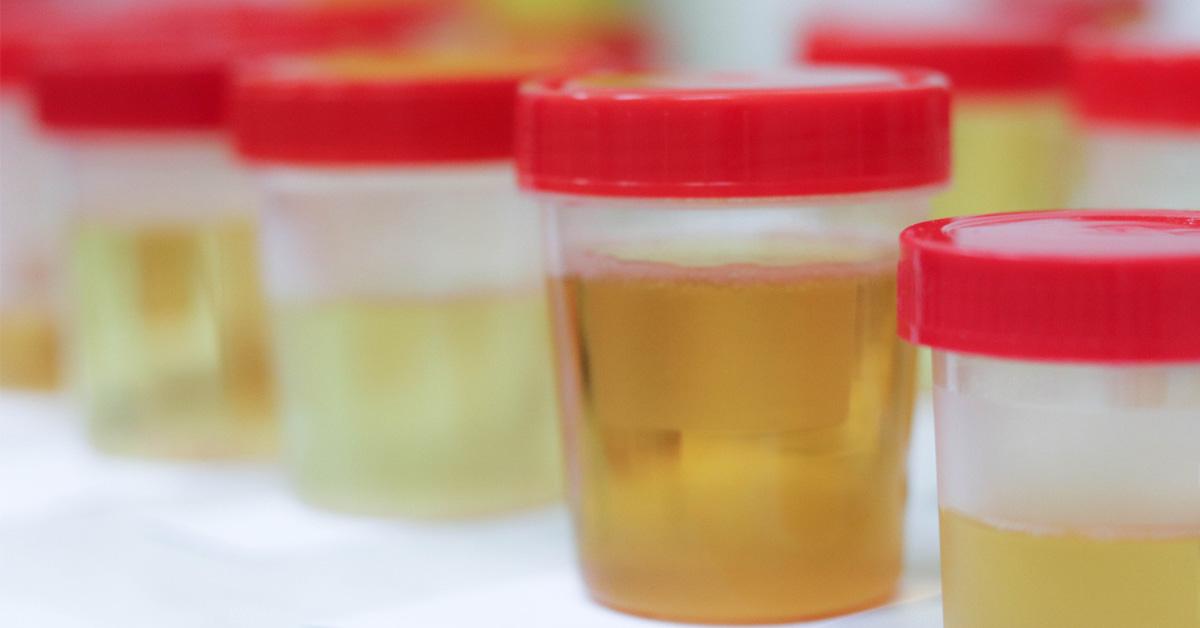 A pontos laboreredmény titka a vizeletgyűjtő pohár helyes használata