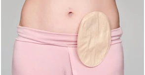 Minőségi élet sztómával is lehetséges - íme 16 tény