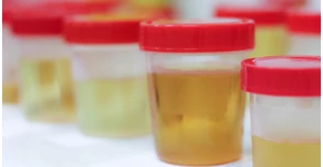 A pontos laboreredmény titka a vizeletgyűjtő pohár helyes használata