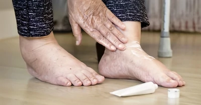 A boka dagadás leggyakoribb okai és kezelési lehetőségei