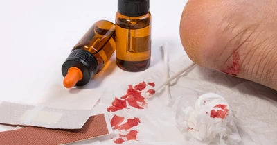 Sebgyógyulás gyorsítása házilag – 12 hasznos tanács, ami segíteni fog