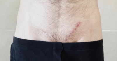 Sebösszehúzó tapasz a hatékony sebzárásért és gyógyulásért