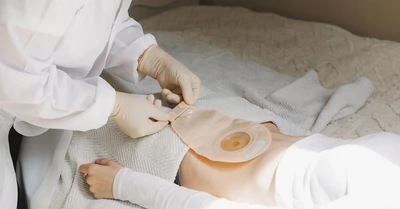 Sztóma – mi a sztóma és hogyan lehet vele élni?