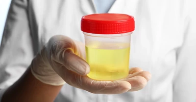 Mik lehetnek a bűzös vizelet okai nőknél?