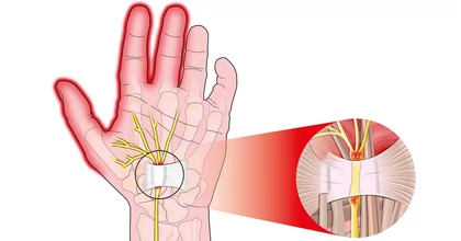 Így enyhíthető a kéztő alagút szindróma – szakértői útmutató