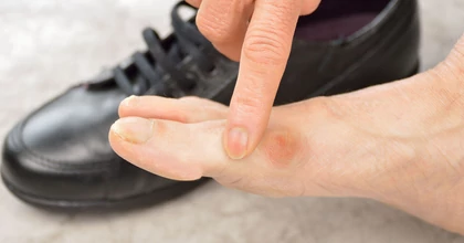 A nagylábujj fájdalom egyre többeket érint - Ön is köztük van?