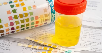 Az alacsony húgysavszint egészségügyi kockázatai és kezelési lehetőségei