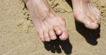 Gyulladt kalapácsujj kezelése házilag