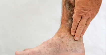 Hogyan néz ki a lábszárfekély, és hogyan ismerhető fel?