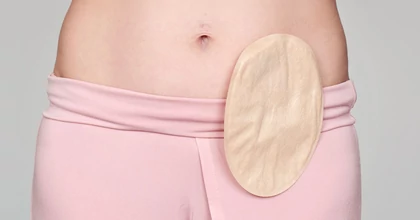 Minőségi élet sztómával is lehetséges - íme 16 tény